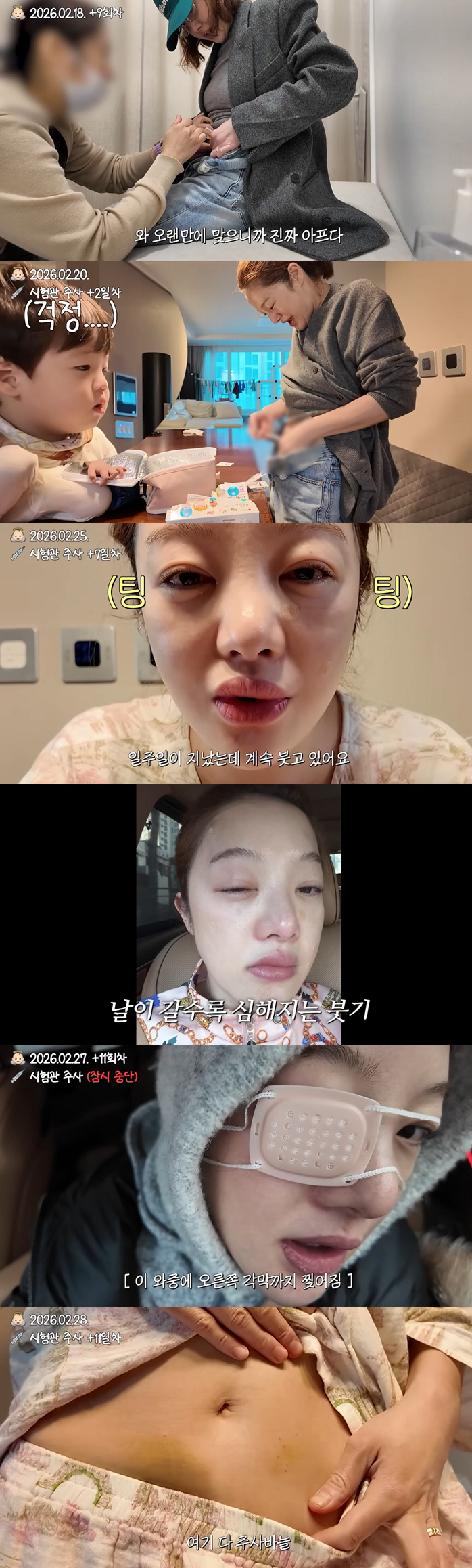 '43세' 황보라, 시험관 주사맞다 얼굴 퉁퉁·멍 투성이..결국 응급실行…