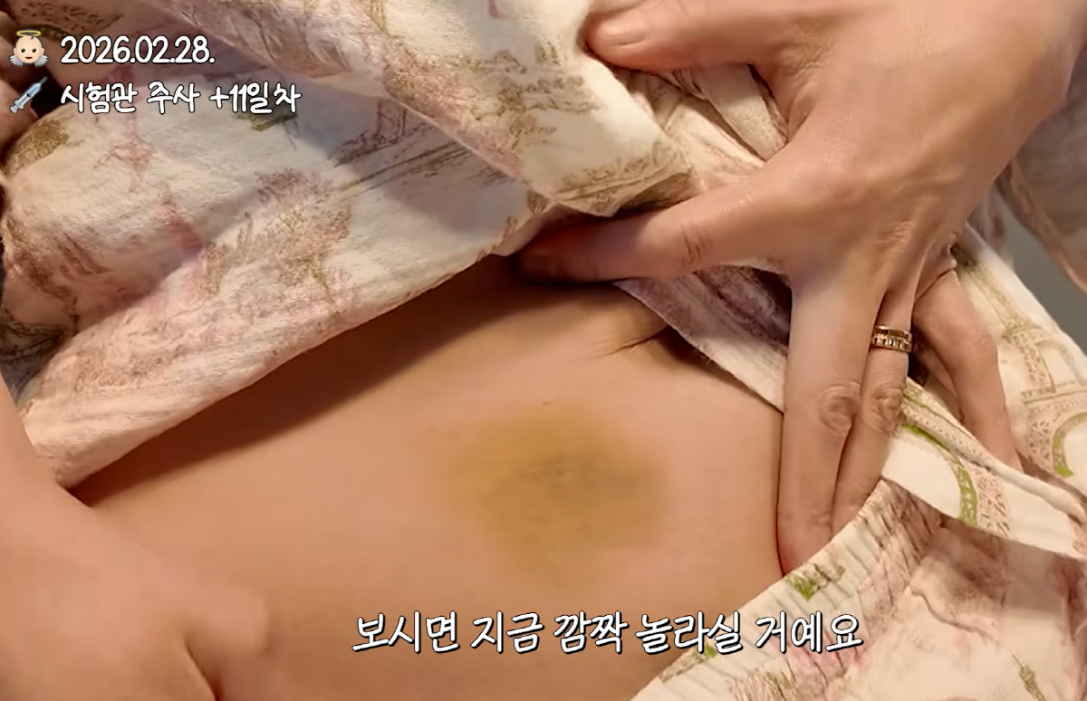 '하정우 제부' 황보라 "시험관 주사맞다 응급실行…배에는 멍 가득" 끝내…