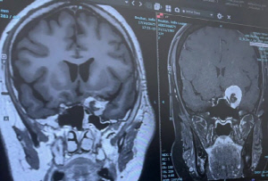 수년간 두통에 생리까지 끊겨…