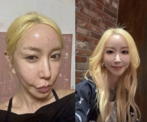 '임효성과 별거' 45세 슈, '얼굴 시술' 효과 이 정도..붉은기→반전 꿀피부