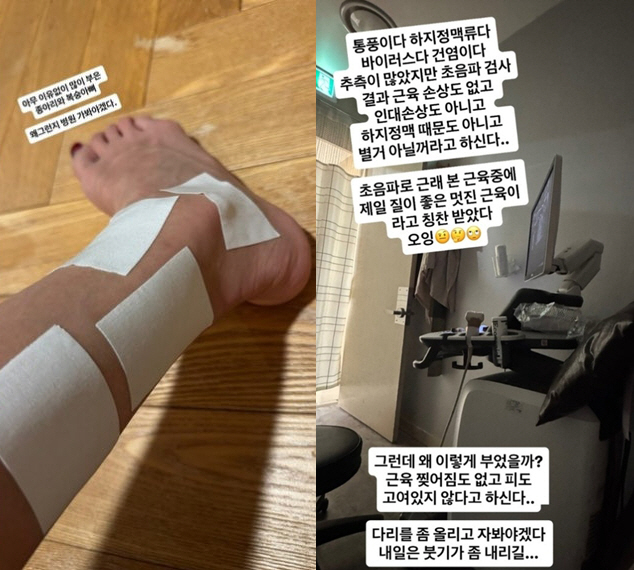 "설마 대상포진인가" 전미라, 심한 부종 후 다리 상태 '충격'