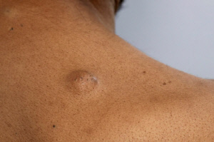 피부에 튀어나온 혹, 지방종 의심…없애야 하나?