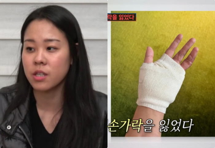 인순이 엘리트 딸, 사고로 새끼 손가락 잃었다