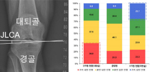 무릎 퇴행성 관절염 가속 진행 예측 지표 확인…O자형 정렬, 위험 4~5배 증가