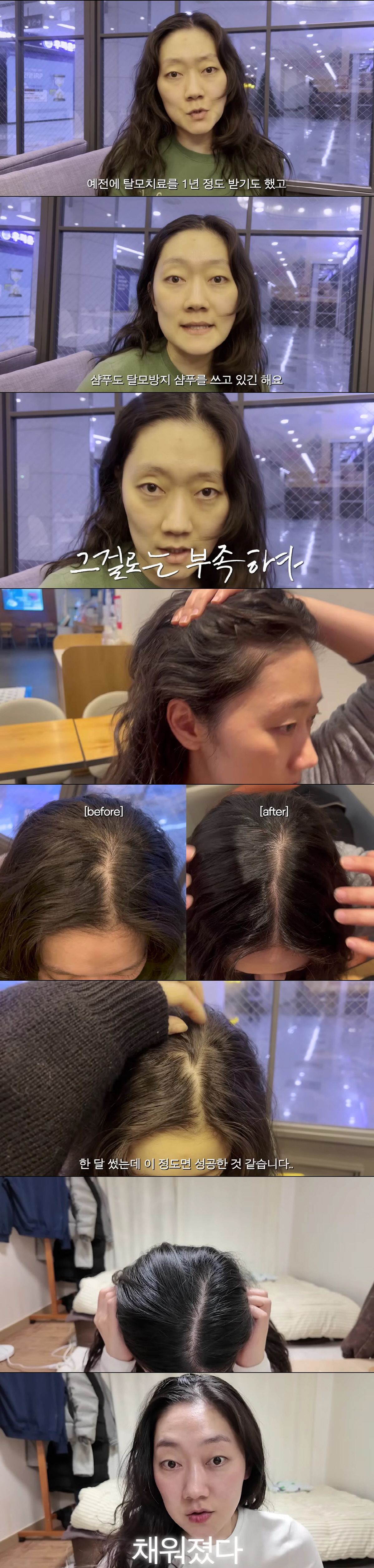 박경혜, 탈모 케어 비포·애프터 공개 "한달 만에 텅빈 정수리 채워져"