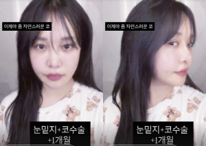 랄랄, 코 눈밑지 하더니 확 바뀐 미모 "1개월 차, 이제 자연스러워"