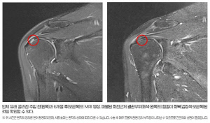 회전근개 부분 파열 '콜라겐 주입' 치료 효과 확인…힘찬병원 "83% 이상, 힘줄 재생"