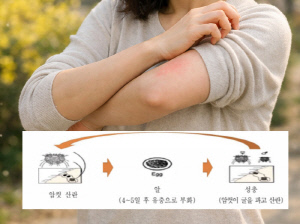 사라진 줄 알았던 '옴' 확산…밤마다 가려움 유발, 피부 질환과 헷갈려