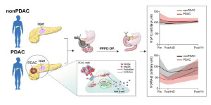 이유 없는 갑작스러운 당뇨병, 췌장암의 경고 신호?