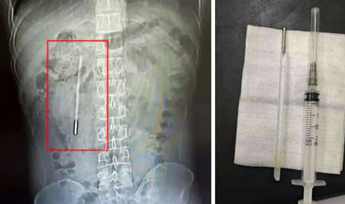 "20년 전 삼킨 체온계가 아직 몸속에"…온전한 형태 유지 화제