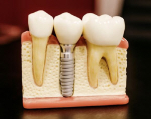 '차세대 티타늄 합금 임플란트' 세계 첫 임상 성공…피로 수명, 기존보다 4배 더 길어