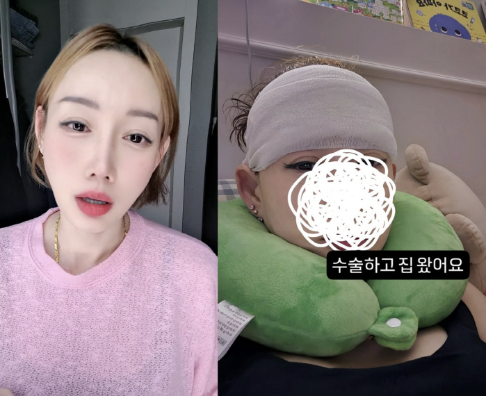 '이숙캠' 김별, 눈썹 뼈·이마 축소 후 달라진 얼굴 "내일은 더 아플 듯"