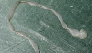 뇌에서 8cm 기생충 발견 '경악'…