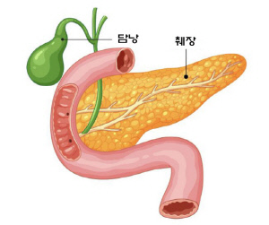 오래된 담석·만성 담낭염, 담낭암 위험…수술 가능 20~30% 불과