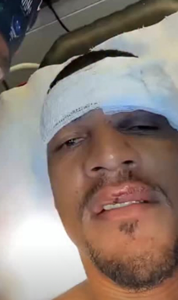 '오버헤드킥에 얼굴 차여 실신' 수술대 올라 입술 30바늘 꿰맸다…다행히 무사 퇴원