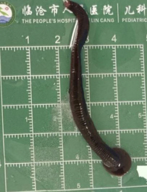 8살 아이 목에서 '살아있는 8㎝ 거머리' 발견…6개월 전엔 코에서 나와