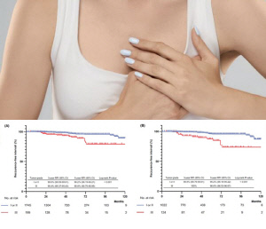 폐경 전 유방암 환자, 더 정교하게 치료할 수 있는 단서 확인