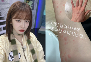 전효성, 원인 불명 알레르기에 '붉은 반점' 뒤덮인 팔 공개…