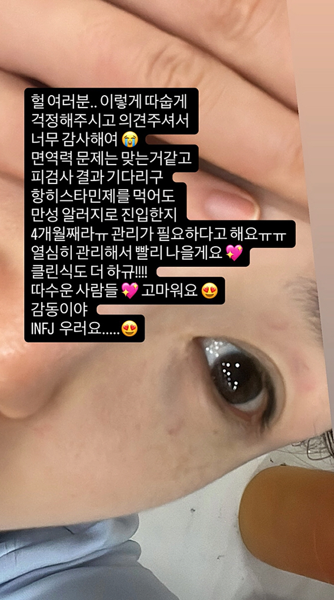 전효성, 원인 불명 알레르기에 '붉은 반점' 뒤덮인 팔 공개…"4개월째 만성 진입" 답답