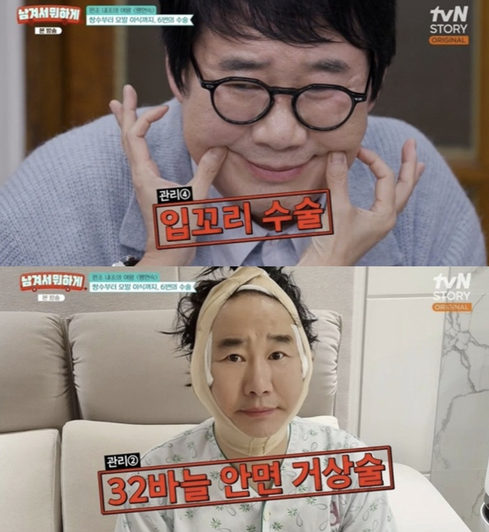 '63세' 최양락, 동안비결 "쌍꺼풀 2번+거상+박피 18번" 충격 수술