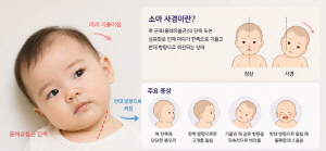 "우리 아이 목이 왜 이러지?"…고개 기울어지는 '소아 사경' 치료는?