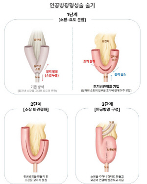 로봇 인공방광 수술 합병증 '소변 누출' 획기적 감소…'조기비관형화' 효과적