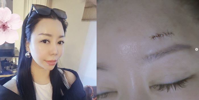 10기 정숙, 갑작스러운 수술 소식 "하필 얼굴에 생겨, 너무 아프고 힘들어"