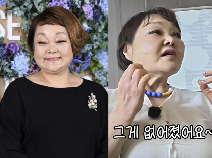 '68세' 이혜정, 실리프팅 시술 전후 깜짝.."심부볼 사라져"