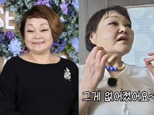 '68세' 이혜정, 실리프팅 시술 전후 깜짝.."심부볼 사라져"