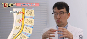 [위클리 건강] 손발 저리고 보행장애까지…목이 보내는 경고 '경추척수증'