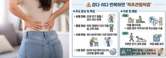 허리디스크인 줄 알았는데 '척추관협착증'…질환 차이는?