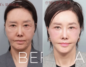 '62세' 유혜리, 안면거상 지방 재배치 후 확 달라진 외모 "못 알아볼 정도"