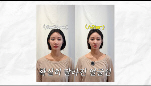 한그루, 이혈 테라피로 확 달라졌다…전후 차이에 충격 "얼굴이 반만 올라가"