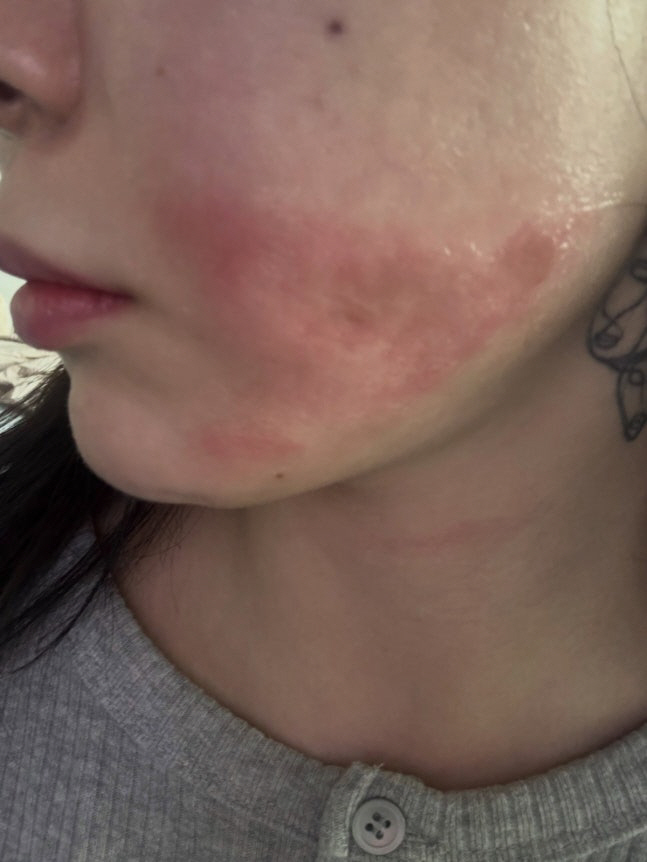 권민아, 화상 흉터 남은 최근 피부 상태.."회복 더뎌 무섭다"
