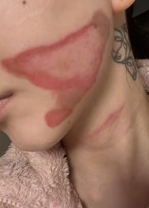 권민아, 화상 흉터 남은 최근 피부 상태.."회복 더뎌 무섭다"