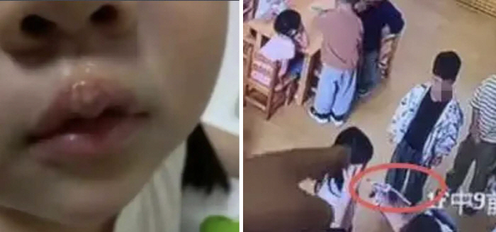 유치원 교사, 접착제로 4세 여아 입술 화상 입혀…아이에게 책임 전가도