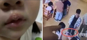 유치원 교사, 접착제로 4세 여아 입술 화상 입혀…아이에게 책임 전가도