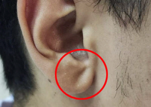 귀를 보면 심장병 위험 안다?…'프랭크 사인'의 경고