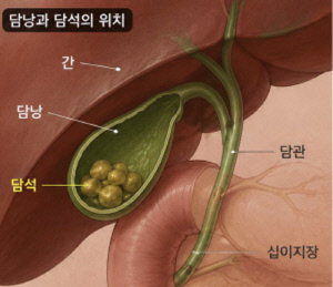 "체한 줄 알았는데 담석?"…소화불량·근육통으로 오인 쉬워