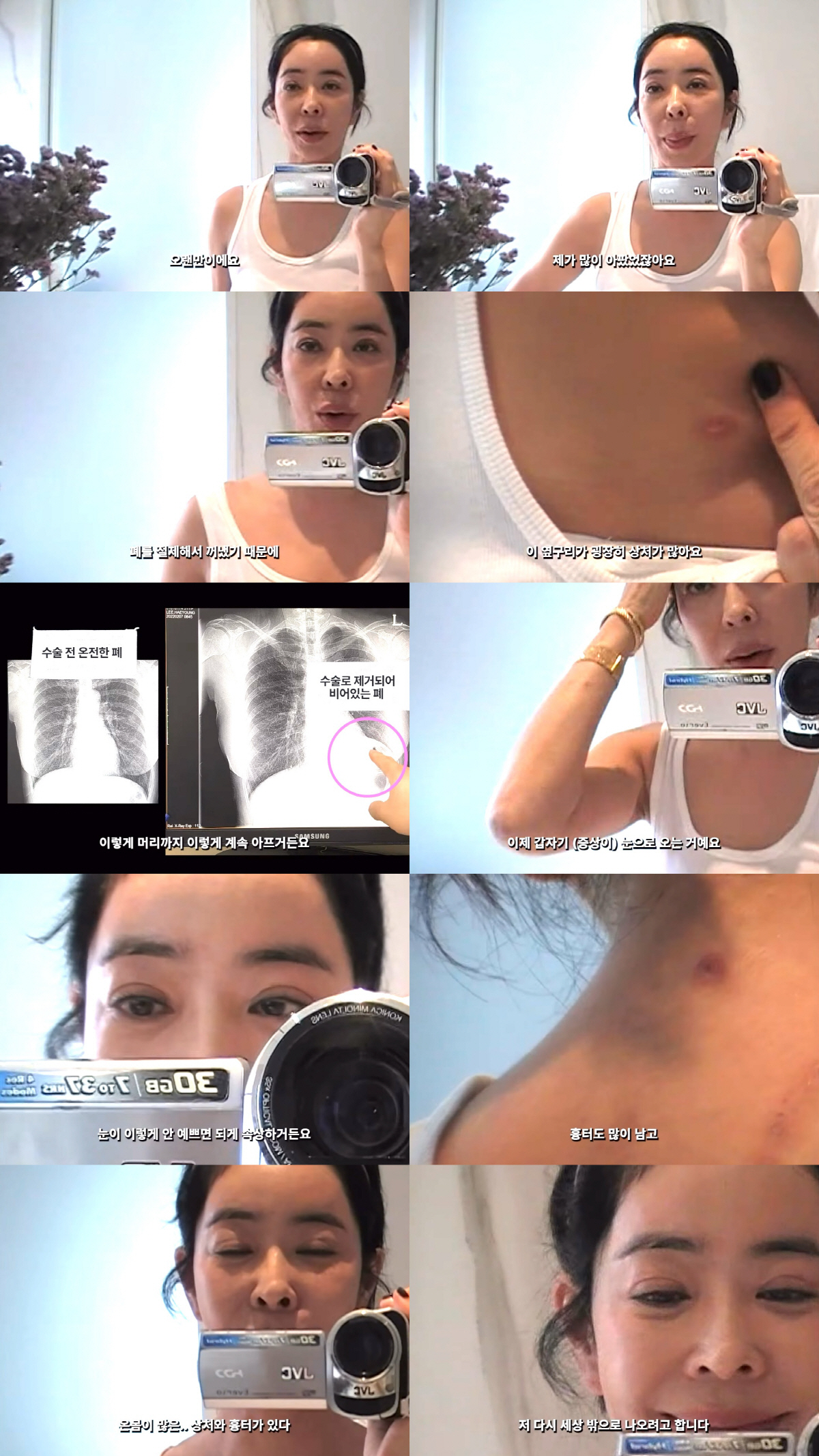 이혜영, 폐암 투병후 퉁퉁부은 눈 "좌절 많이 해, 온몸이 흉터 투성이"