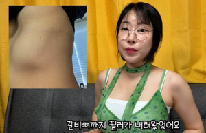 "가슴이 4개가 됐다" 이세영, 필러 부작용 사진 첫 공개 '충격'