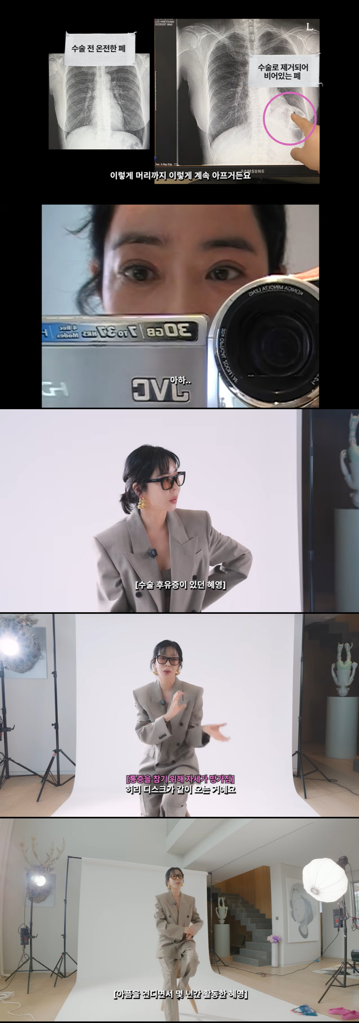 '폐암 투병' 이혜영 "폐 절제 후 합병증, 고통 참다 목·허리 디스크까지 와"