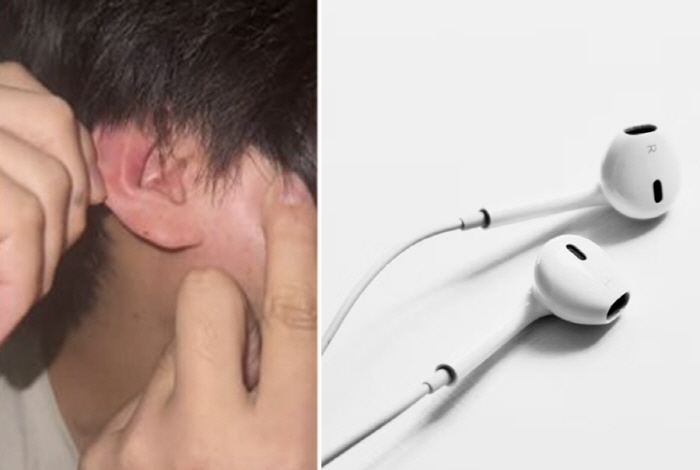 Fell Asleep Listening to Music, Then a Loud Pop Earbuds Overheat and Explode in Shocking Incident