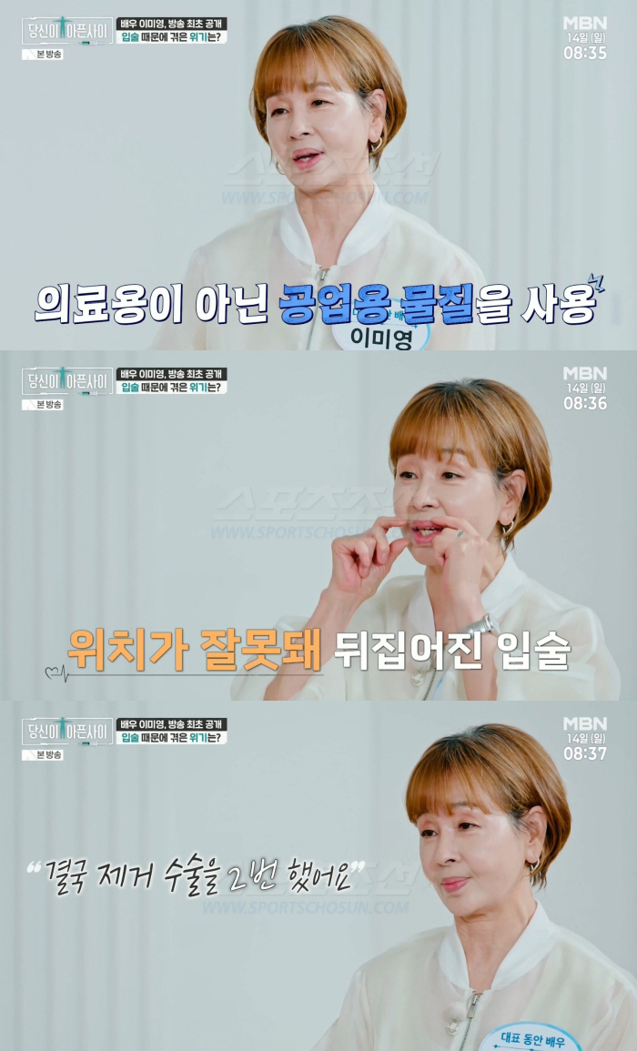 이미영, 뒤집어진 입술..필러 부작용 고백 "공업용 물질 넣어 제거 수술만 두 번"