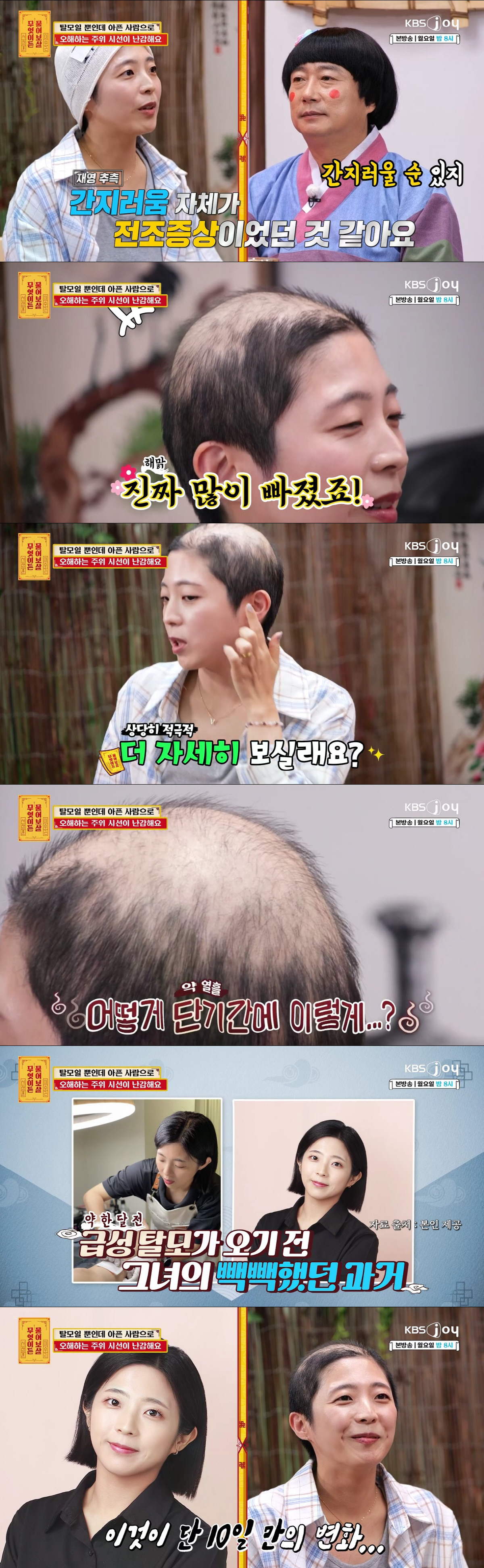 10일 만에 대머리 됐다..30대女, 원인불명 급성 탈모 "남편이 더 힘들어 해"(물어보살)