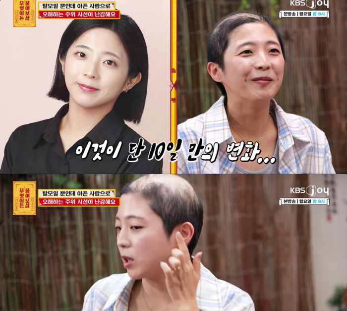 10일 만에 대머리 됐다..30대女, 원인불명 급성 탈모 "남편이 더 힘들어 해"(물어보살)