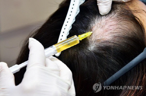 [기자수첩] 탈모 건보 확대 논쟁…치료제 지원인가 건보재정 고갈인가