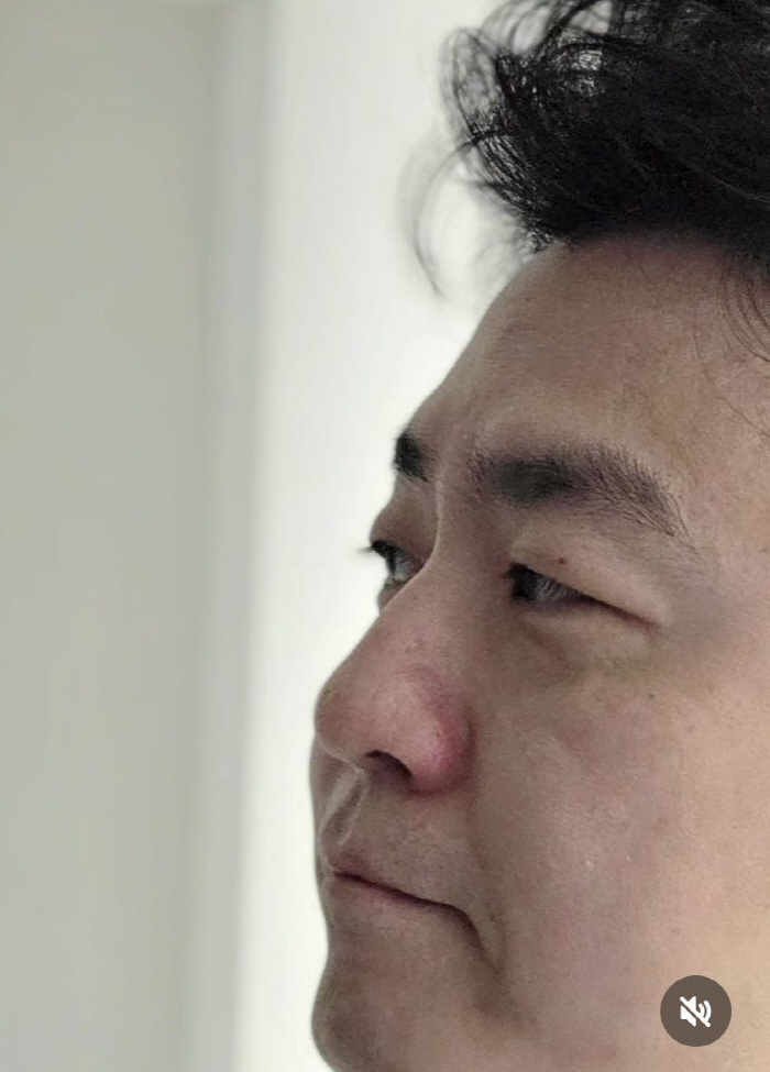 '박지윤과 파경' 최동석, 이혼 후 달라진 얼굴..얼마나 변했길래 코끝이 쑥 "콧볼 줄고 콧대 올라가"