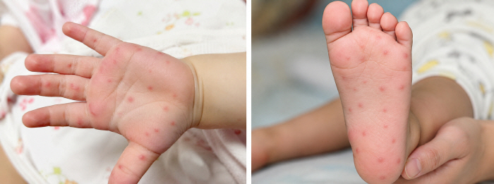 ◇If small blisters appear on the palms and soles, HFMD should be suspected. AI-generated image