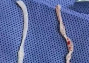 1년간 커진 팔 혹의 정체…10㎝ 기생충 2마리 발견 '경악'